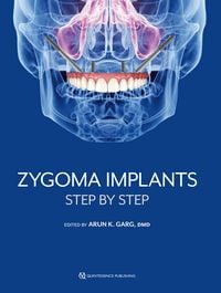 Produktbild: Zygoma Implants