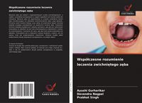 Produktbild: Wsp&oacute;&iquest;czesne rozumienie leczenia zwichni&iquest;tego z&iquest;ba
