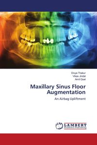 Produktbild: Maxillary Sinus Floor Augmentation
