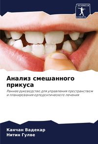 Produktbild: Analiz smeshannogo prikusa