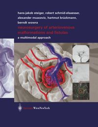 Produktbild: Neurosurgery of Arteriovenous Malformations and Fistulas
