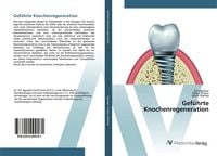 Produktbild: Gef&uuml;hrte Knochenregeneration
