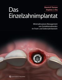 Produktbild: Das Einzelzahnimplantat